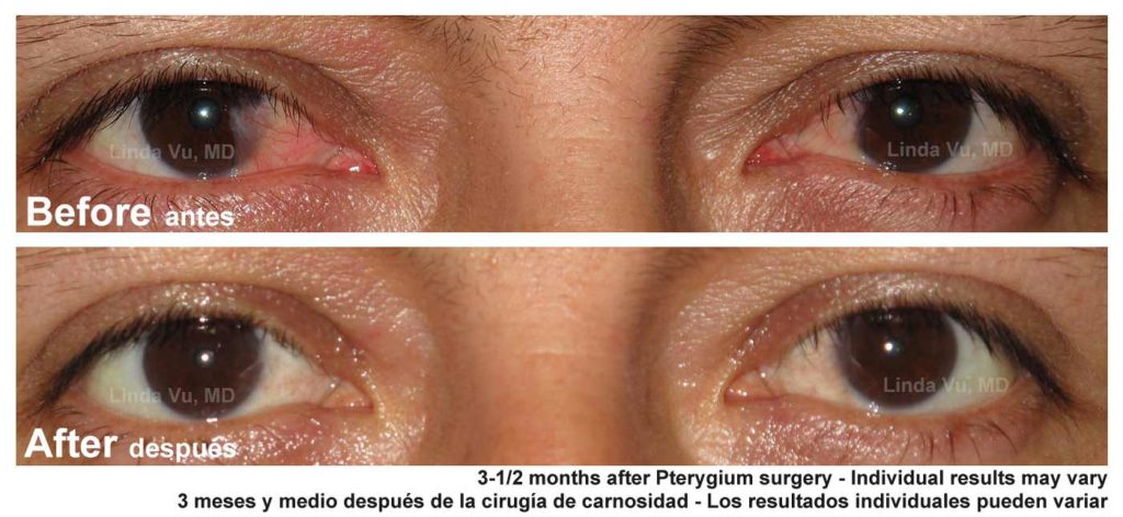 Pterygium Surgery - Dr Monawwar Khan - Specialist Ophthalmic Surgeon